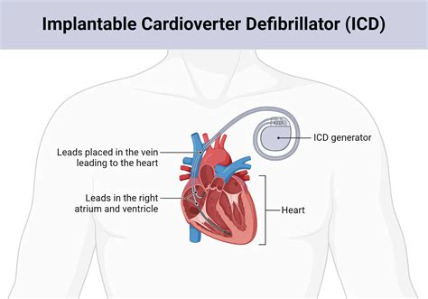 defibrillator price harvey norman|Heart Defibrillator: Uses, Implantation, ICD Longevity .